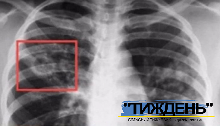 Це важливо знати про туберкульоз