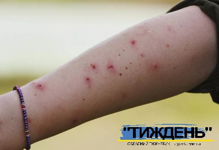 Сезонні загрози: у регіонах фіксують спалахи гепатиту, активність кліщів і мошок